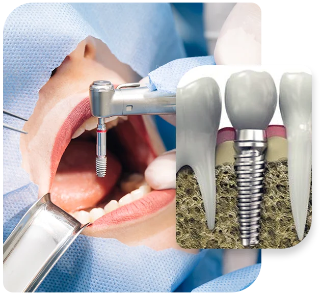 Dental-Implant-Service