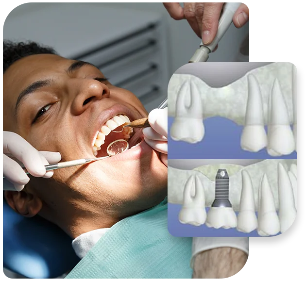 Bone-Grafting-Procedure