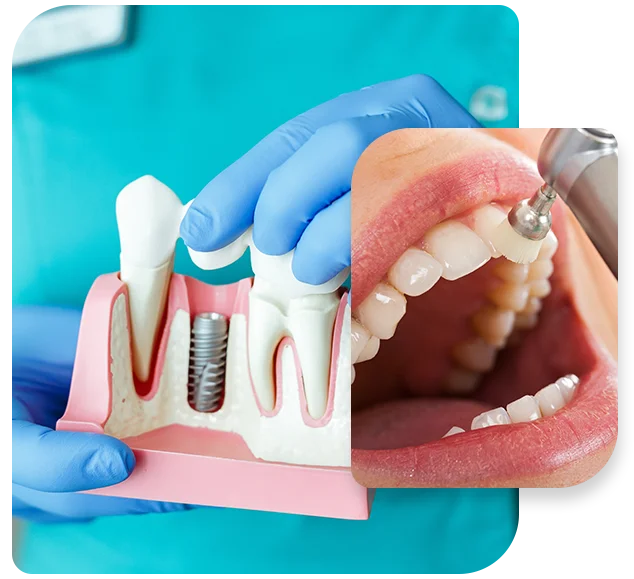 Piedmont-Oral-Implant-Instructions
