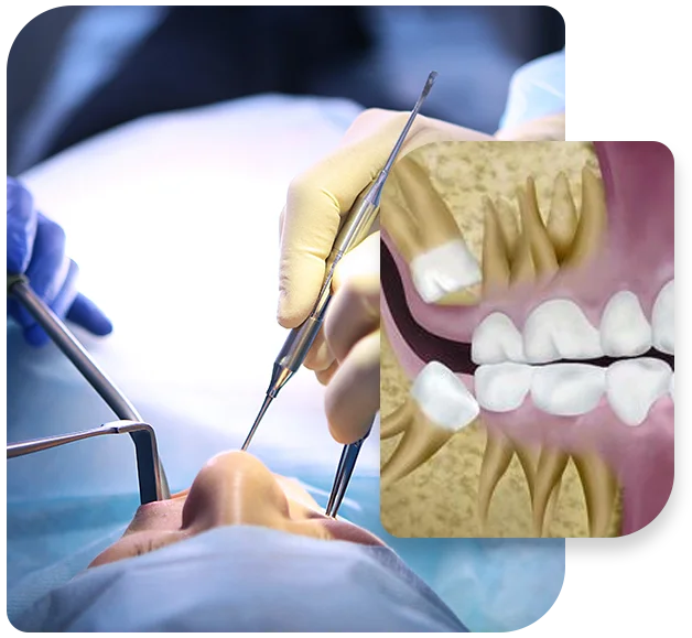 Wisdom Teeth Procedure